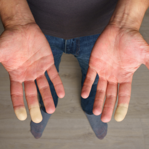 Fenômeno de Raynaud: quando os dedos mudam de cor